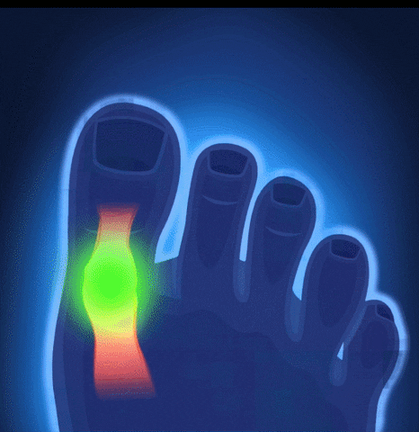 Corretor Profissional de Joanete (Usado por Ortopedistas) - Kaype Store