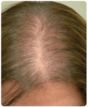 Alopecia